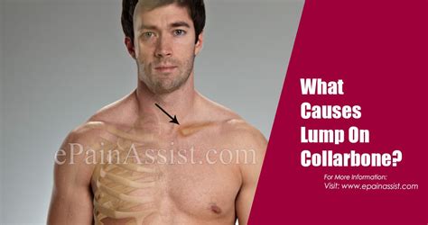 What Causes Lump On Collarbone And How Is It Treated