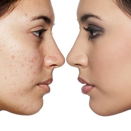 Acne Treatment Course • LC Aesthetics & Skincare Academy • Hair, Beauty