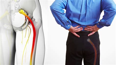 What Is Sciatica Causes And Treatment Youtube