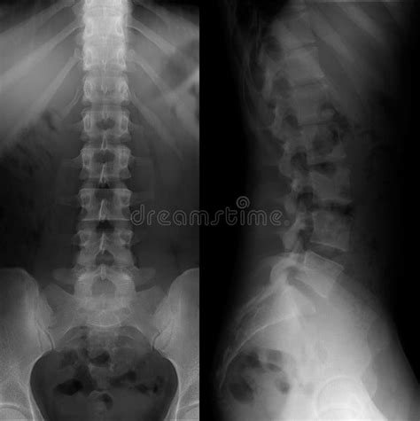 X Ray Of The Lumbosacral Spine Normal Perfect Stock Photo Image Of