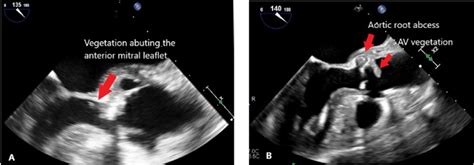 Transesophageal Echocardiogram A Aortic Valve Vegetation Extending
