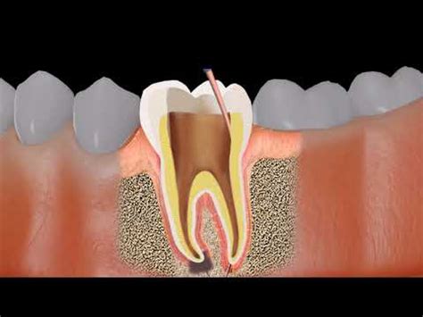 Root Canal Treatment RCT Procedure Animation YouTube