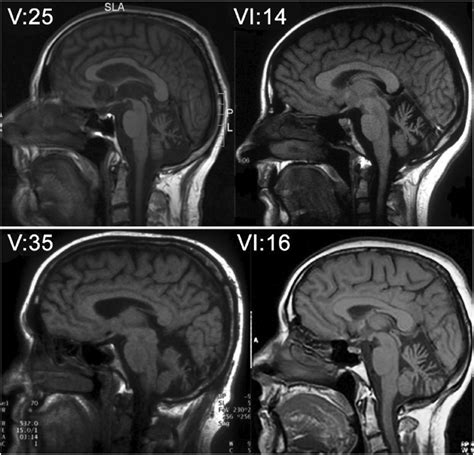 Brain Imaging Midline Sagittal T1 Weighted Brain Magnetic Resonance