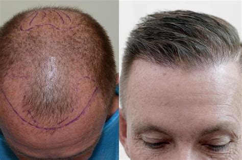 Different Types Of Hair Transplant Procedures Hair Transplant Zohal