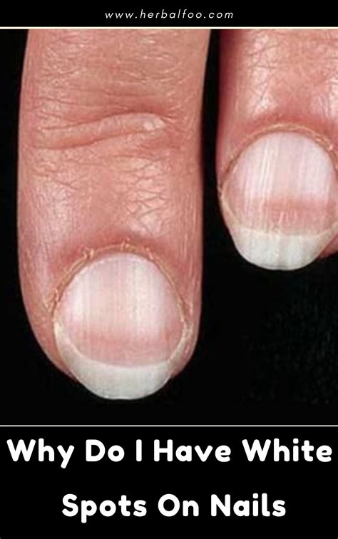 16 White Spots On Fingernails Pregnancy 2022 Fsabd42