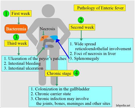 Typhoid Fever The Steps