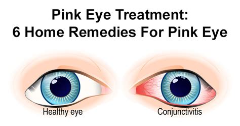 Pankaj Kashyap Pink Eye Treatment 6 Simple Home Remedies For Pink Eye
