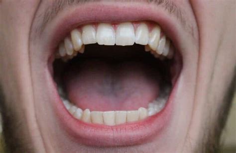 Bump Or Lump On The Roof Of Mouth Causestreatmenthome Remedies