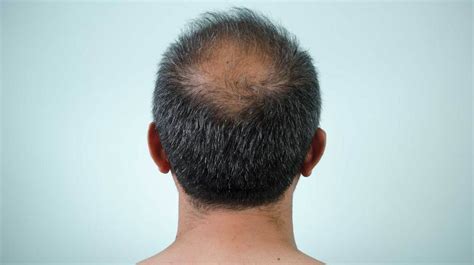 Conclusion on best balding clippers for black hair. Scalp Conditions: Pictures, Causes, and Treatments