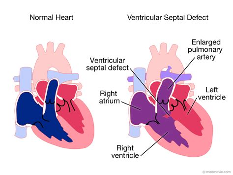 What Are Ventricular Septal Defects Images And Photos Finder