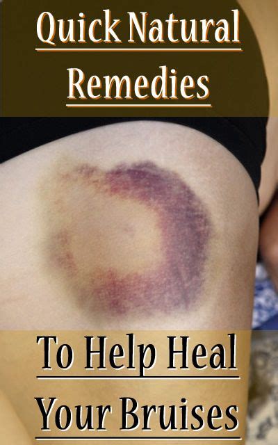 Quick Natural Remedies To Help Heal Your Bruises Heal Bruises Bruises Remedy Remedies