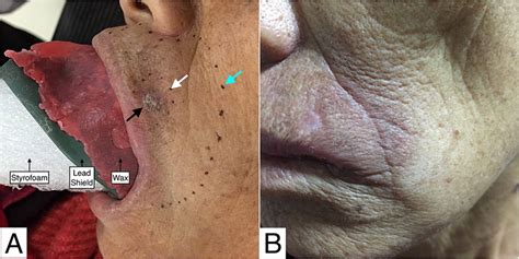 Successful Treatment Of Squamous Cell Carcinoma Of The Lip With