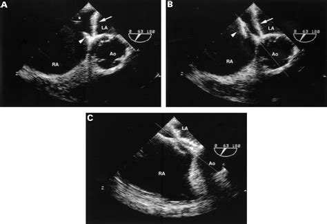 Transcatheter Closure Of Atrial Septal Defects Using The Cardio Seal