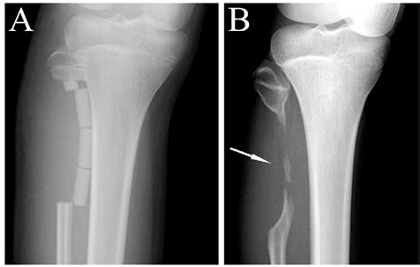 Radiographs Of A 12 Year Old Female With Osteoid Osteoma Case 1