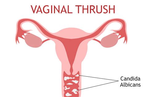 Vaginal Thrush Causes Symptoms And Treatment Emedihealth