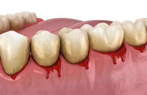 Bleeding Gums Causes Treatment And Prevention