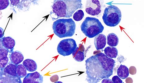 Image Gallery Lymph Node Cytology Clinicians Brief