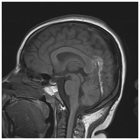 Early Imaging Characteristics Of 62 Cases Of Cerebral Venous Sinus