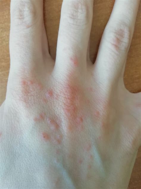 Сыпь на руке в течение 5 дней Вопрос дерматологу 03 Онлайн