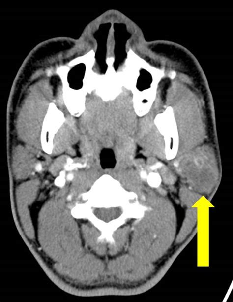 Pleomorphic Adenoma Of Parotid Gland Radiology Cases