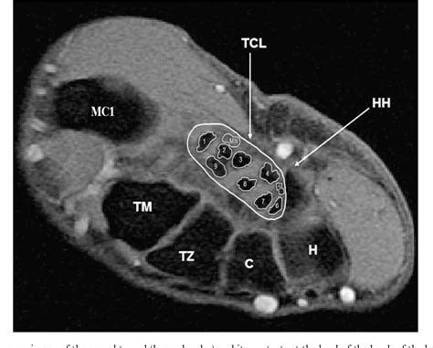 Figure 1 From An Mri Evaluation Of Carpal Tunnel Dimensions In Healthy