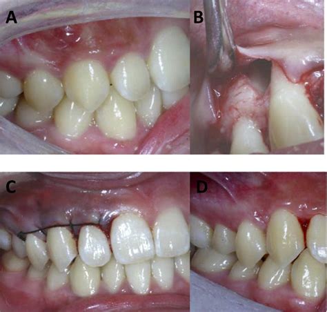 Uncommon Fusion Of Teeth And Lateral Periodontal Cyst In A Chinese Girl