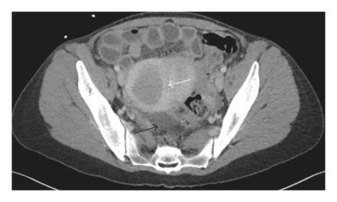 Initial Ct Scan Upon Presentation A B With Uterine Fibroids White