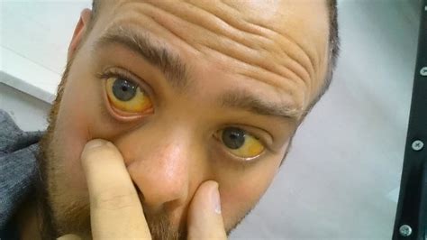 Jaundice Symptoms Causes And Other Risk Factors