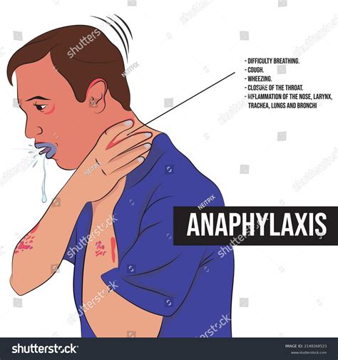 Anaphylaxis Extremely Severe Allergic Reaction That Stock Vector