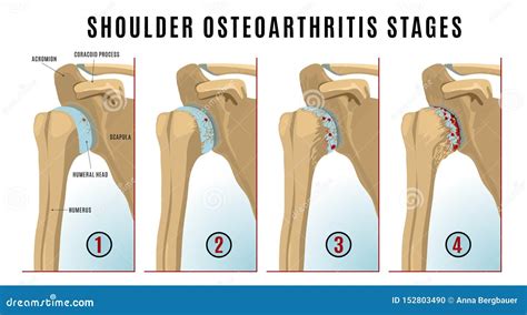 Shoulder Osteoarthritis Infographic Stock Vector Illustration Of