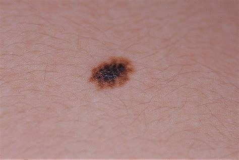 Melanoma Pictures Compare It With Other Conditions