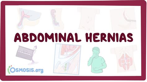 Abdominal Hernias Video Anatomy And Definition Osmosis