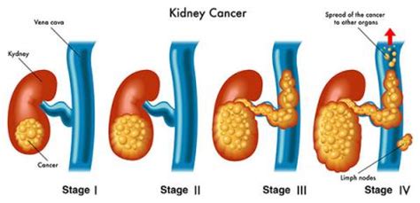 As renal lymphoma progresses, it may cause kidney disease. St George Urology | Kidney Cancers