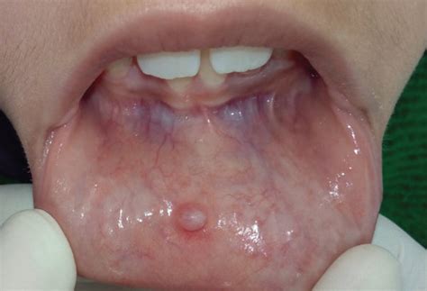 Clinical Appearance Of The Mucocele In The Lower Lip Download