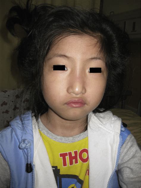 figure 2 facial dysmorphism with hypertelorism short philtrum and bulbous nose tip