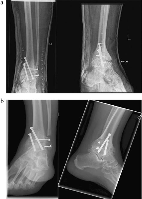 Figure 3 From Outcome Of Ankle Arthrodesis Using A Transfibular