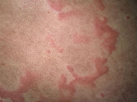 What Causes Red Blood Spots On Skin