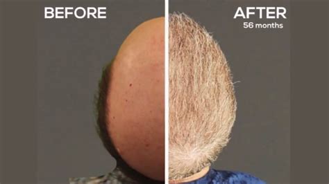 Severe Norwood 7 Hair Transplantation Results Youtube