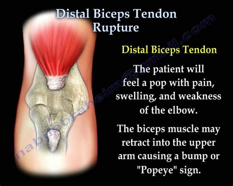 Distal Biceps Tendon Rupture Everything You Need To Know Dr Nabil E Bicep Tendonitis
