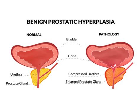 11 Benign Prostatic Hyperplasia Faqs Prostate Enlargement Medfin