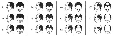 Norwood Classification Of Male Pattern Hair Loss Mphl Download