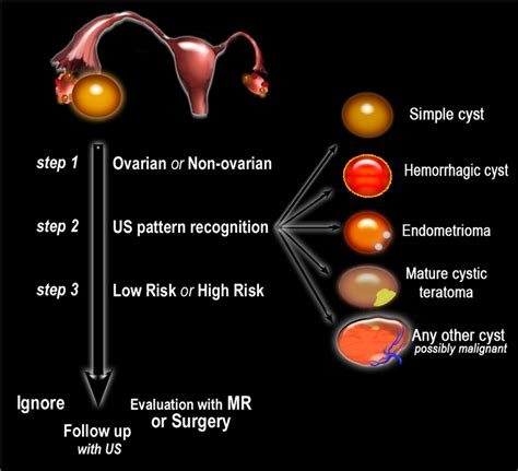 The Radiology Assistant Ovarian Cysts Diagnostic Work And Roadmap