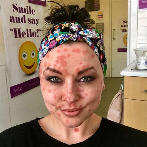 Psoriasis Sufferer Whose Face Is Covered In Red Blotches Wears Spots