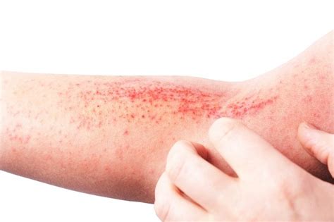 Stasis Dermatitis Ketahui Penyebab Gejala Dan Pengobatannya Alodokter