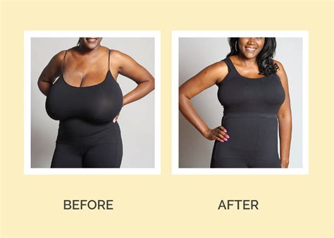 Breast Reduction Archives Skin Arts Aesthetics