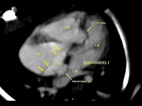 Aneurysmal IV Septum With Bidirectional IAS YouTube