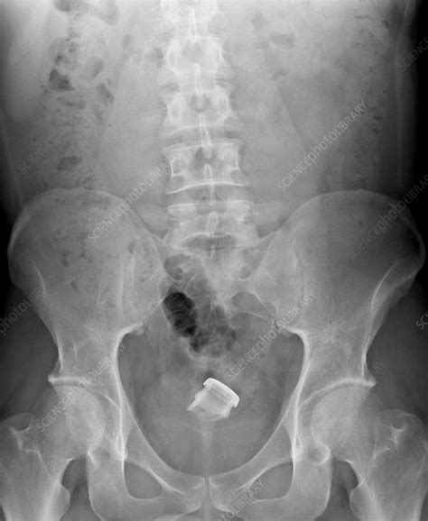 Drinks Bottle In Man S Rectum X Ray Stock Image C007 0562 Science Photo Library