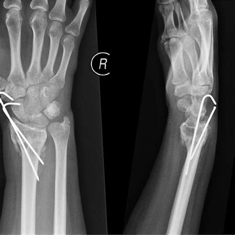 Ap And Lateral Plain Radiographs Of Right Wrist 6 Weeks After Fixation