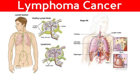 lymphoma cancer