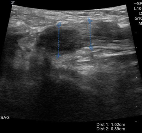 Patellar Tendon Rupture An Ultrasound Case Report Bmj Case Reports My